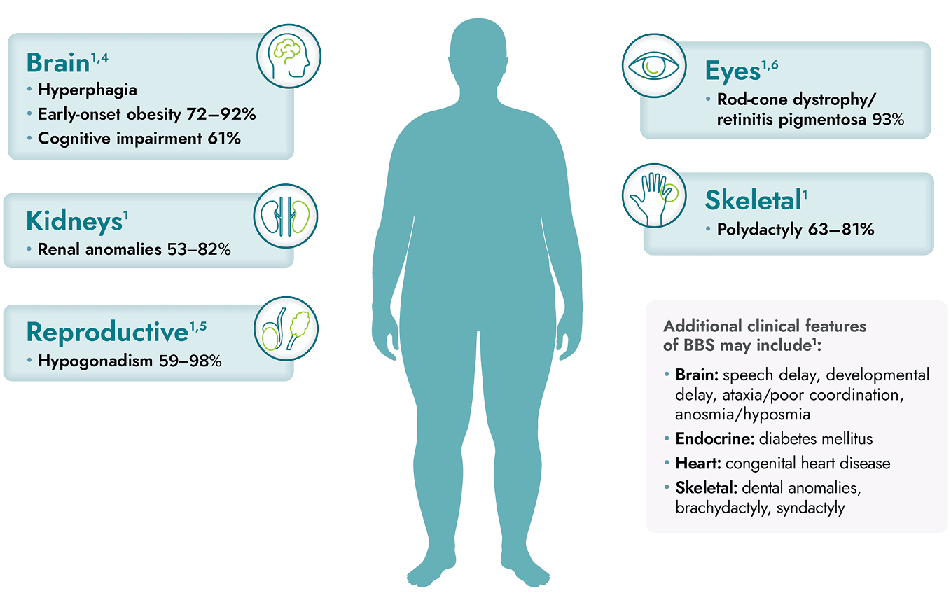 Body diagram identifying BBS symptoms in the brain, kidney, eyes, heart, reproductive, endocrine, and skeletal systems