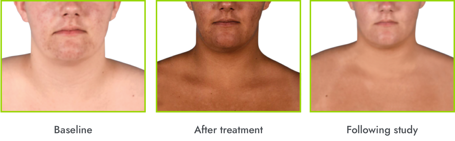 Example of hyperpigmentation before, during, and after stopping IMCIVREE treatment