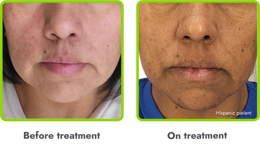 Examples of hyperpigmentation (before and during
treatment with IMCIVREE