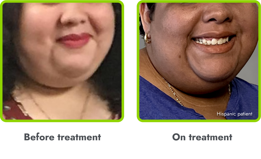 Examples of hyperpigmentation (before and during
treatment with IMCIVREE