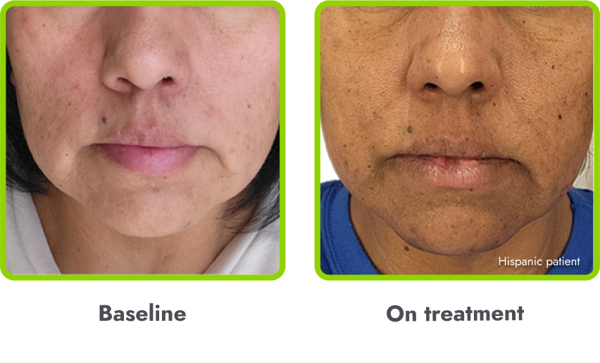 Examples of hyperpigmentation (before and during
treatment with IMCIVREE)