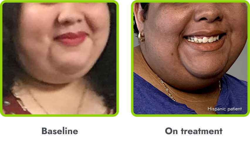 Examples of hyperpigmentation (before and during
treatment with IMCIVREE)