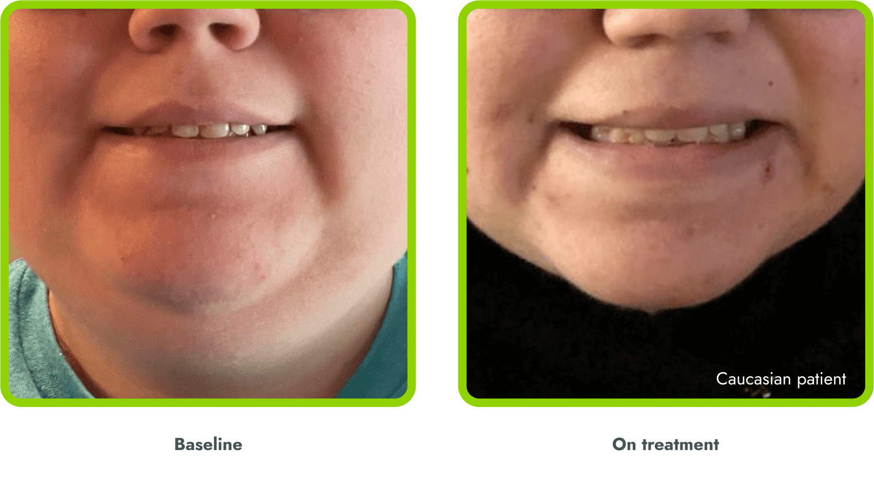 Examples of hyperpigmentation (before and during
treatment with IMCIVREE)