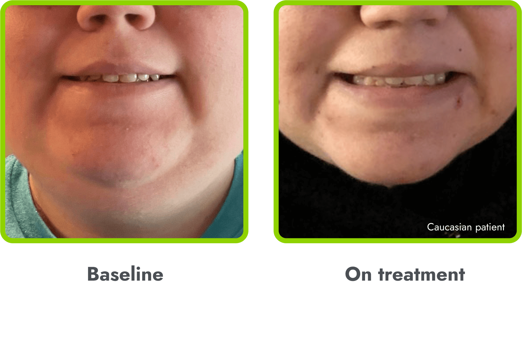 Examples of hyperpigmentation (before and during
treatment with IMCIVREE)