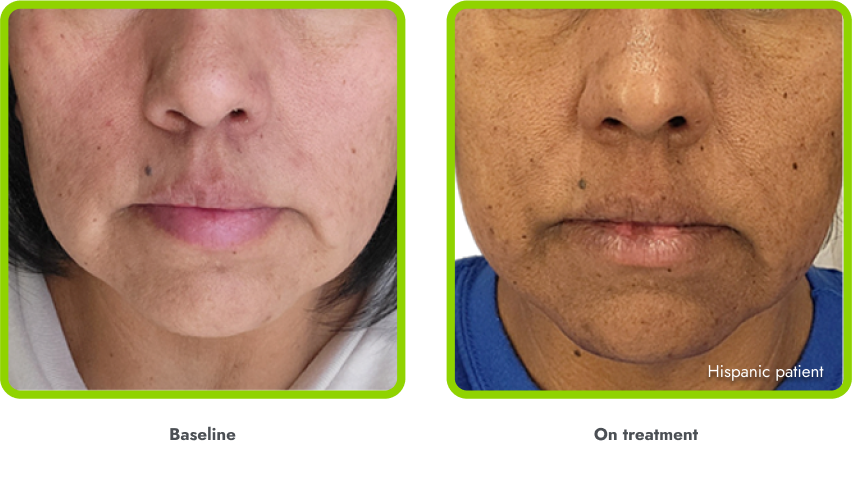 Examples of hyperpigmentation (before and during treatment with IMCIVREE)