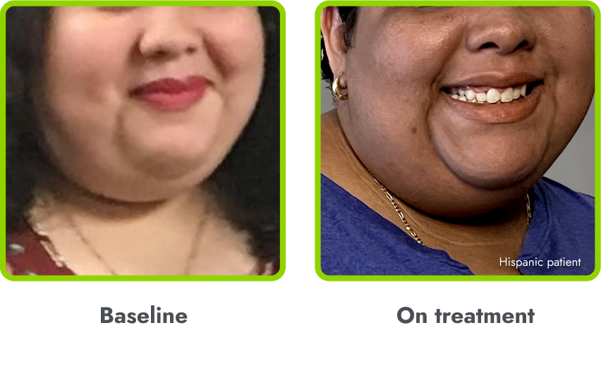 Examples of hyperpigmentation (before and during treatment with IMCIVREE)