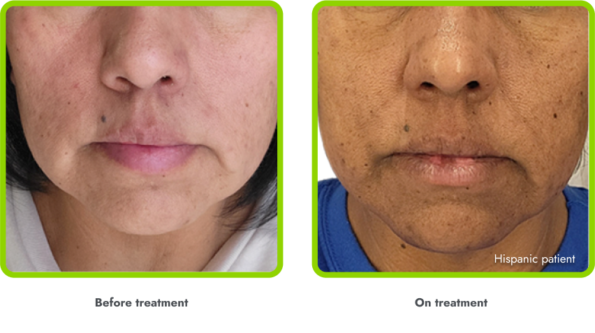 Examples of hyperpigmentation (before and during
treatment with IMCIVREE)