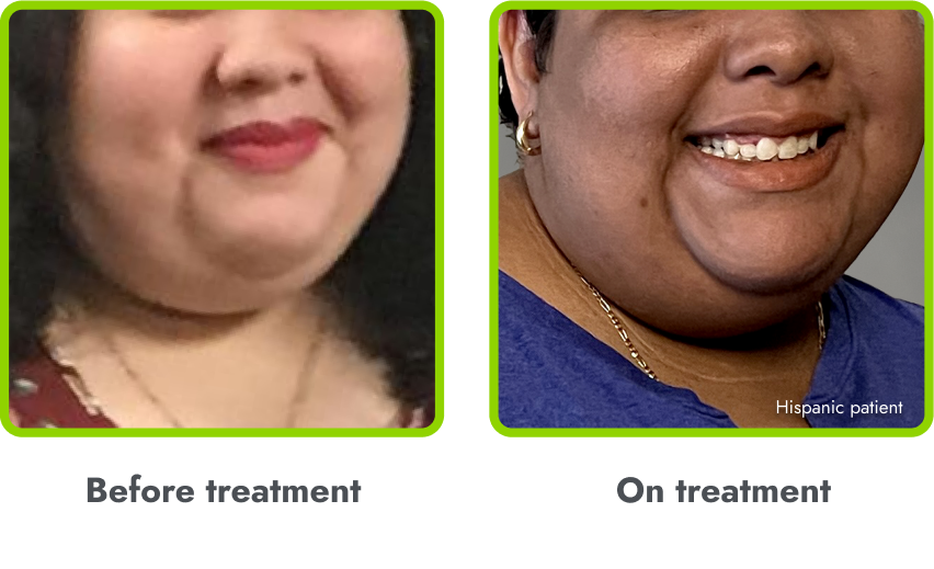 Examples of hyperpigmentation (before and during
treatment with IMCIVREE)
