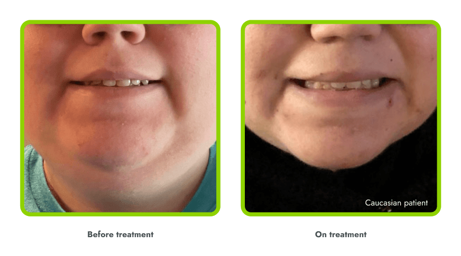 Examples of hyperpigmentation (before and during
treatment with IMCIVREE)
