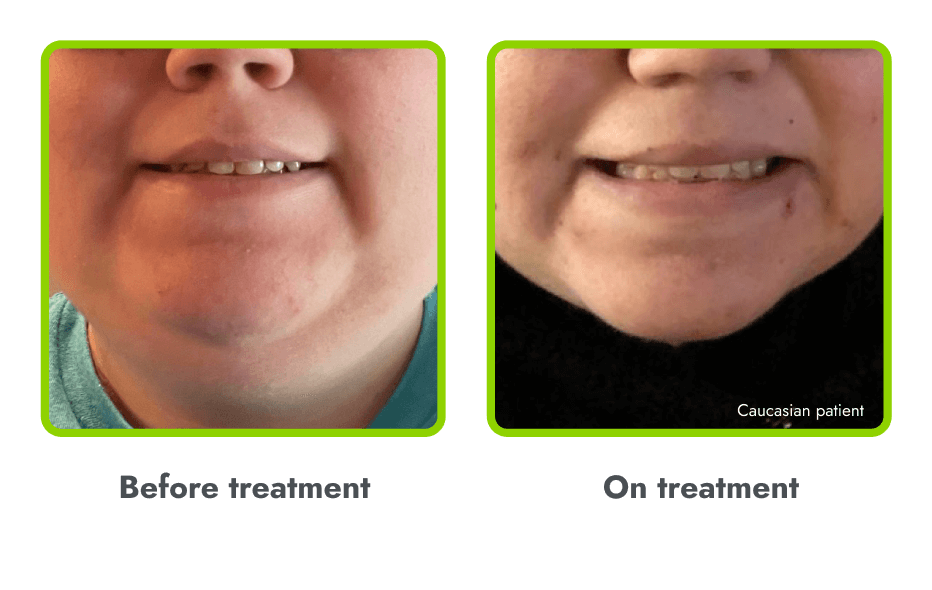 Examples of hyperpigmentation (before and during
treatment with IMCIVREE)
